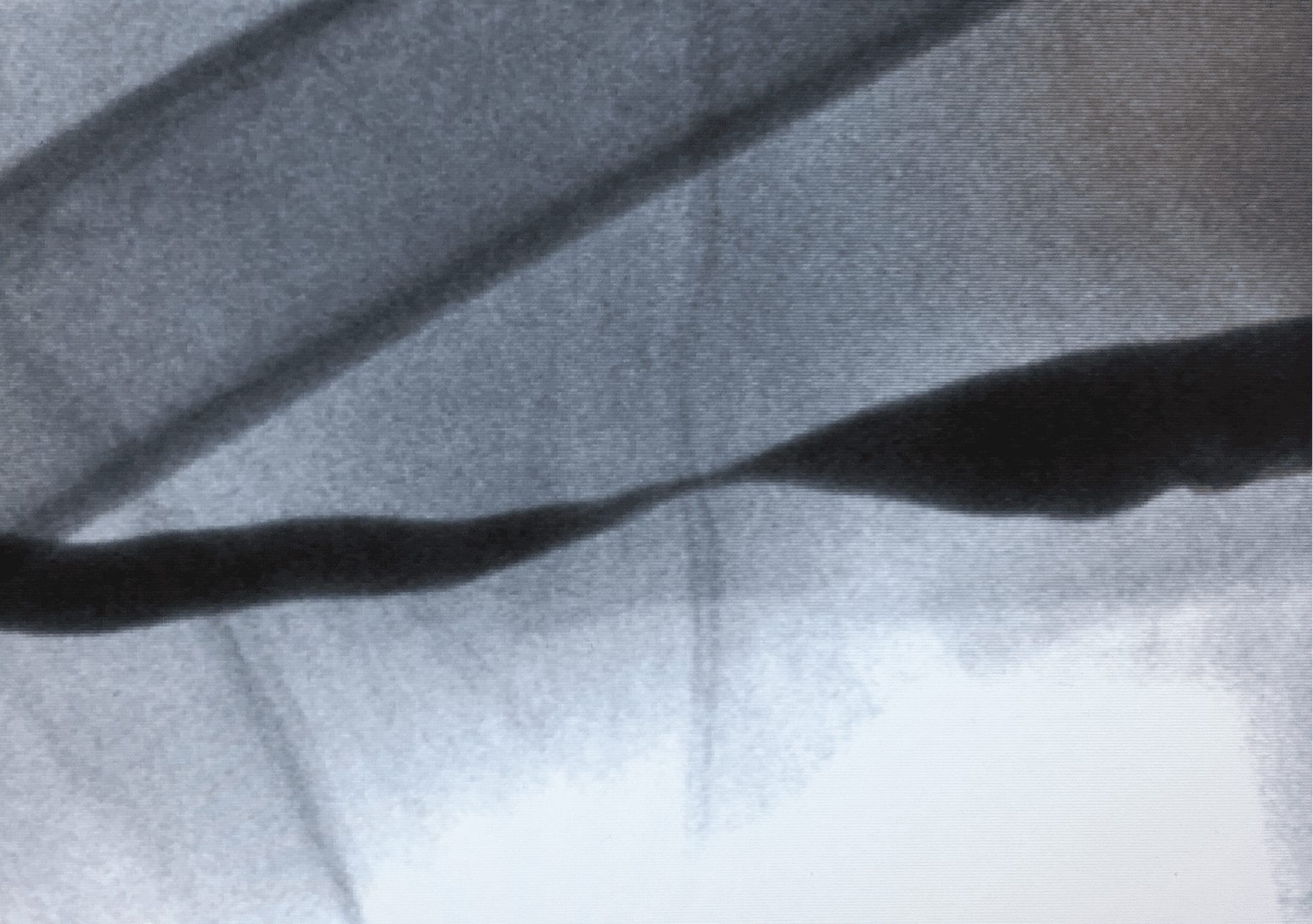 An angiogram of a patient with ESRD with a severely occluded arteriovenous fistula.